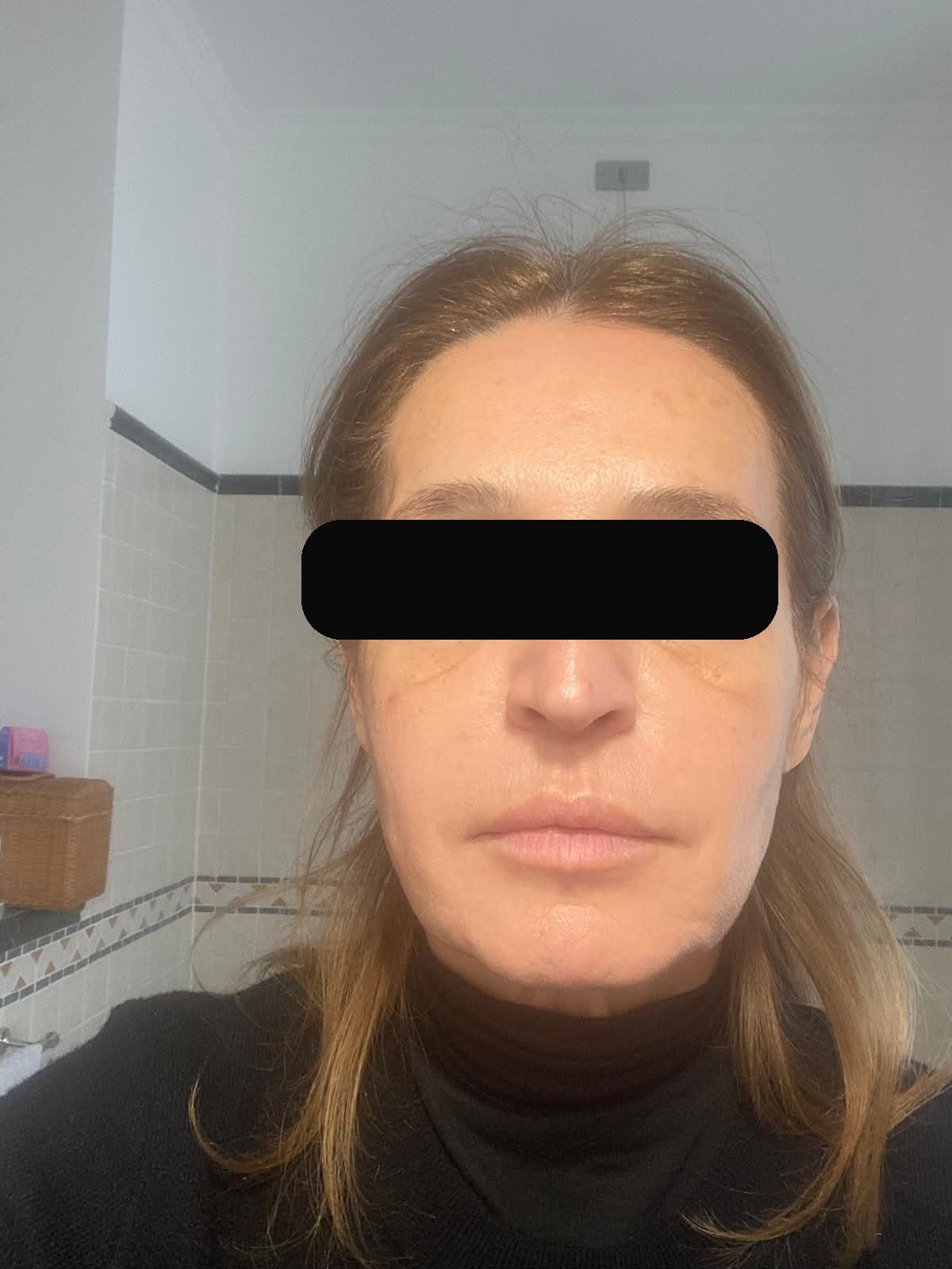 After — subject face, eyes obscured