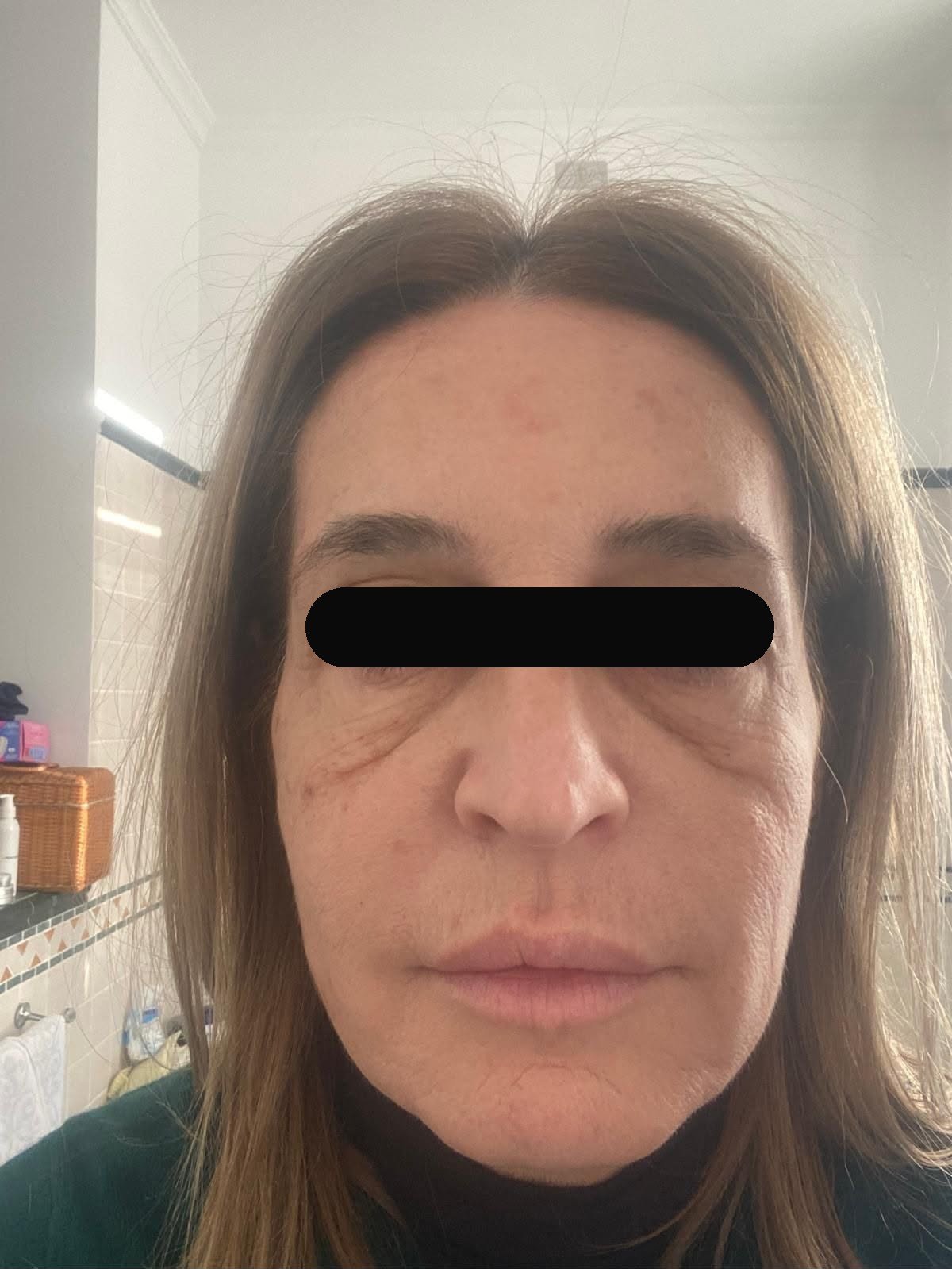 Before — subject face, eyes obscured